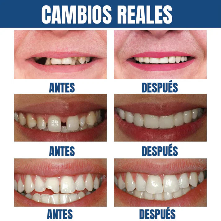 Kit de Reparación Dental Temporal: Recupera tu Sonrisa al Instante ✨🦷